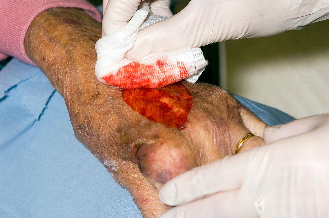 Dressing a hand wound