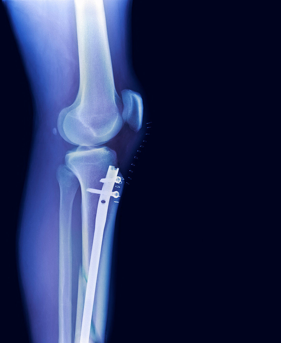 Pinned leg fracture,X-ray