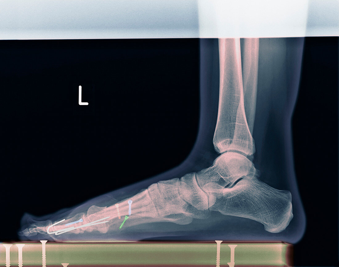 Pinned foot,X-ray