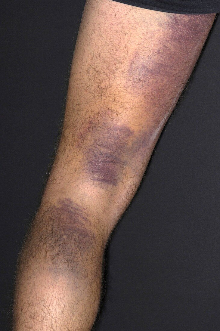 Bruised leg