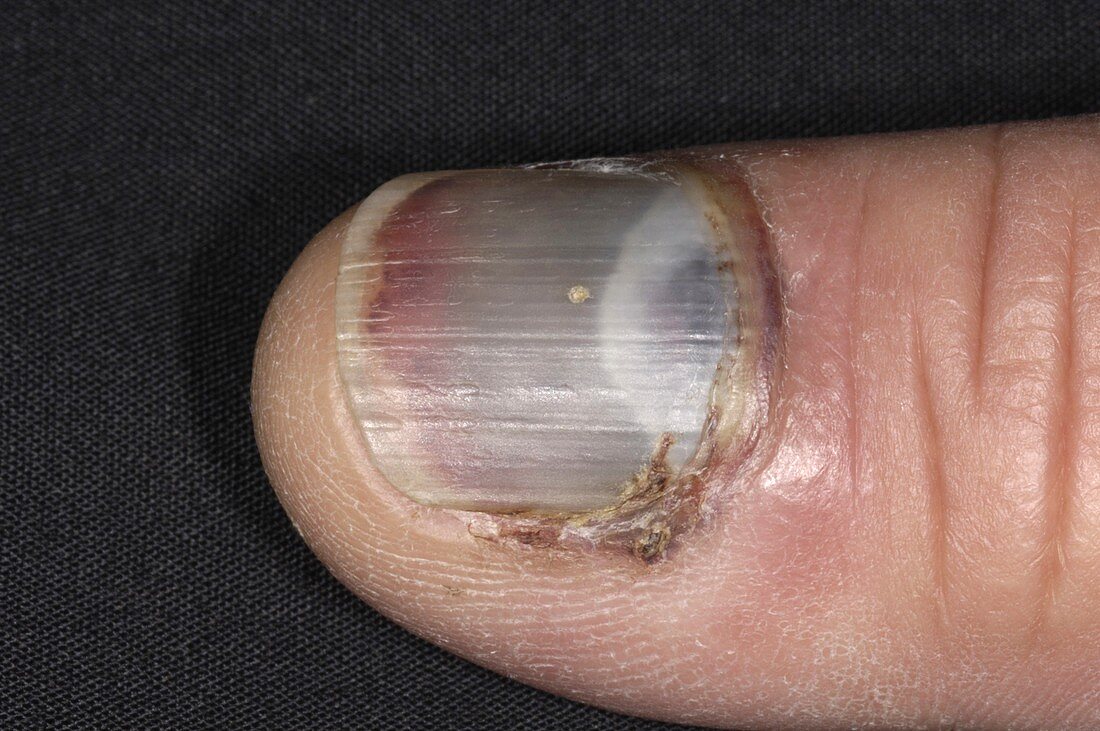 Bruised fingernail
