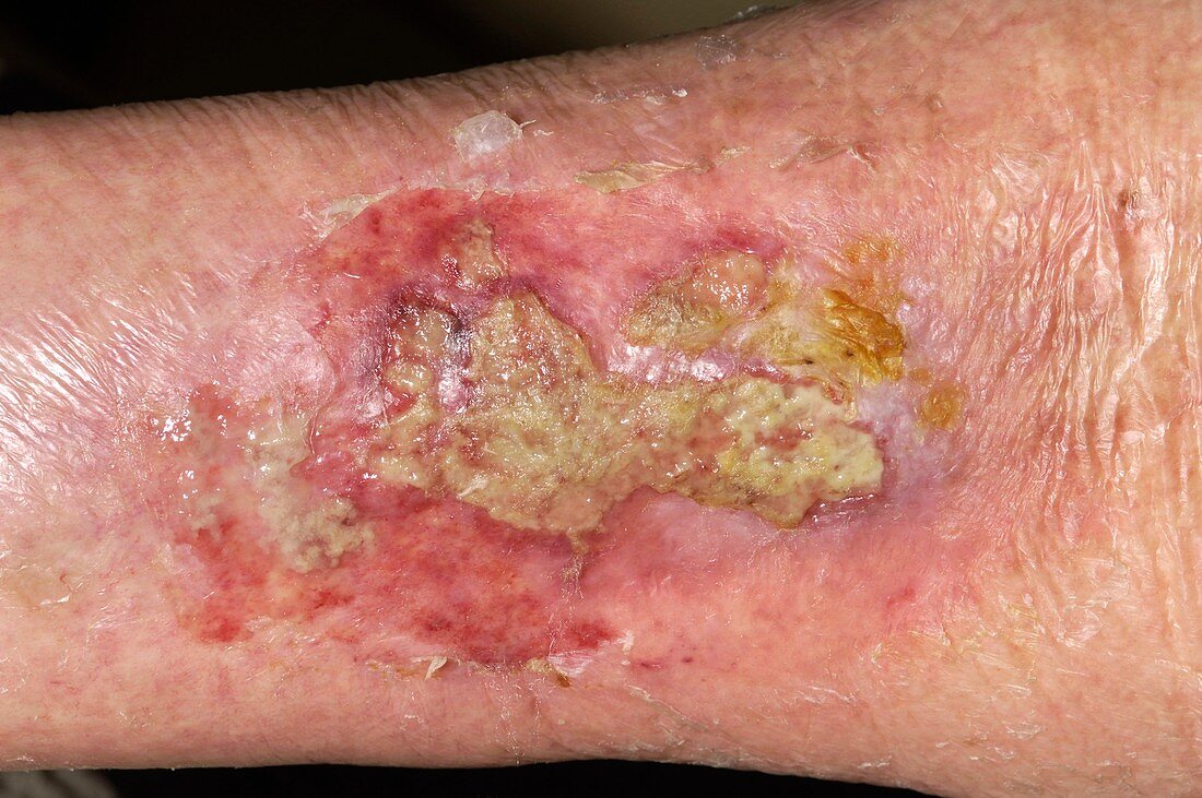 Infected wound