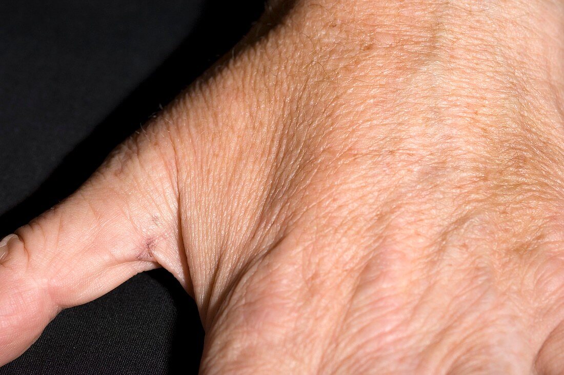 Muscle wasting in thumb