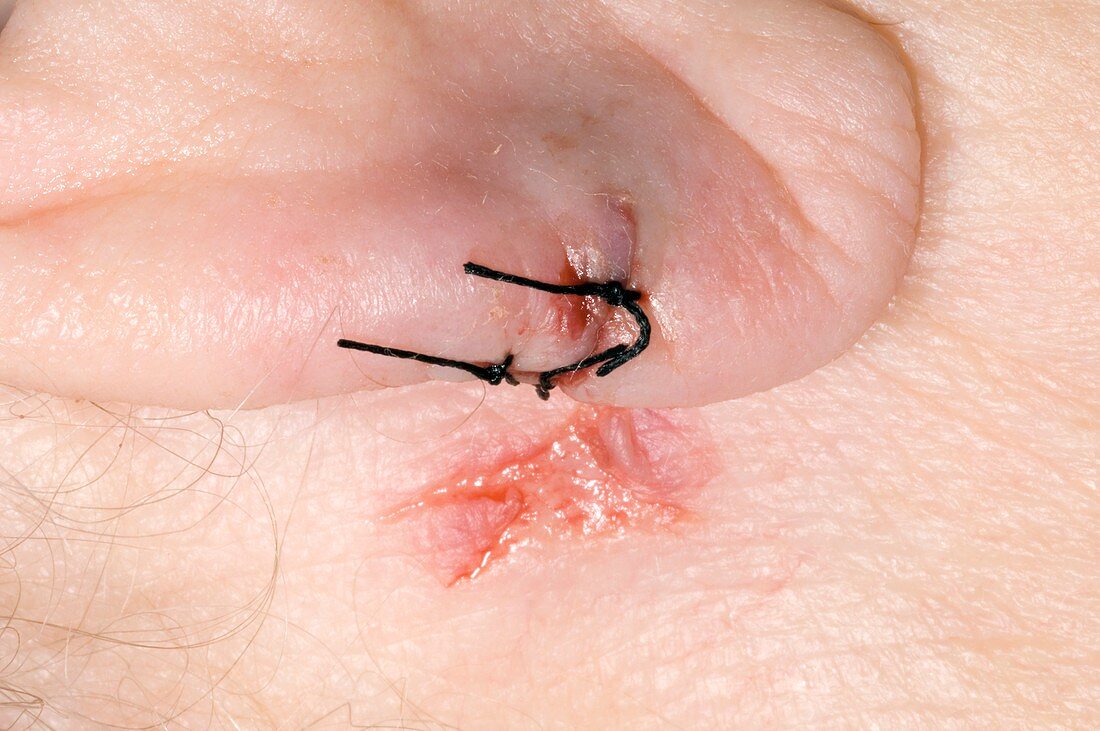 Stitched earlobe