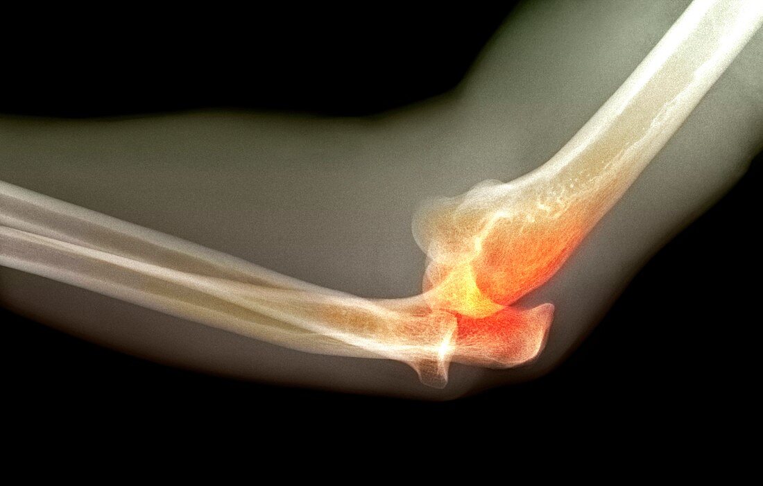 Dislocated elbow,X-ray