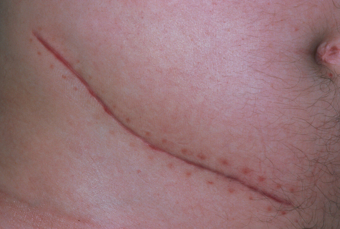 Appendicectomy scar