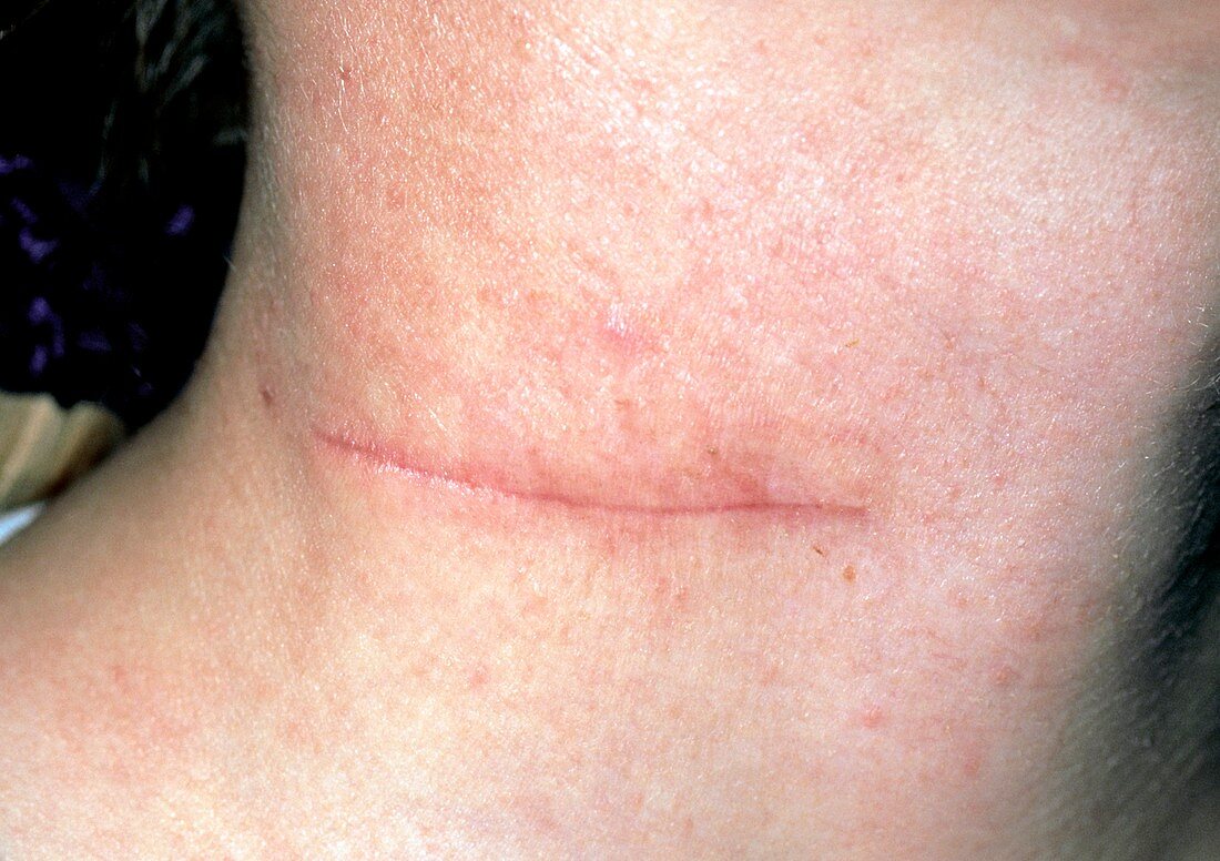 Scar on the neck after removal of branchial cyst