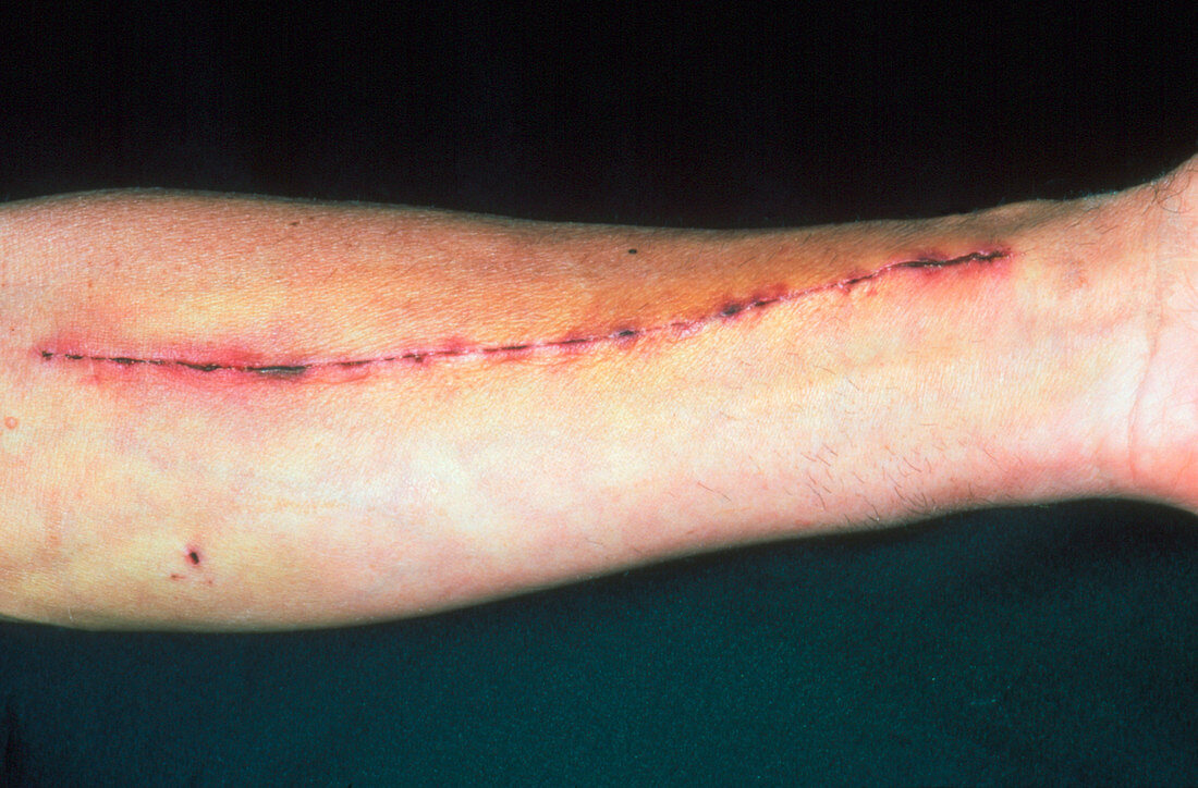 Radial artery excision scar on man's arm