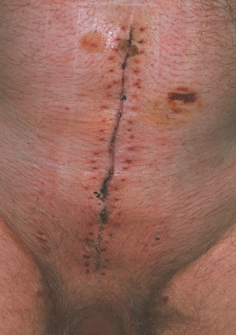 Hernia scar
