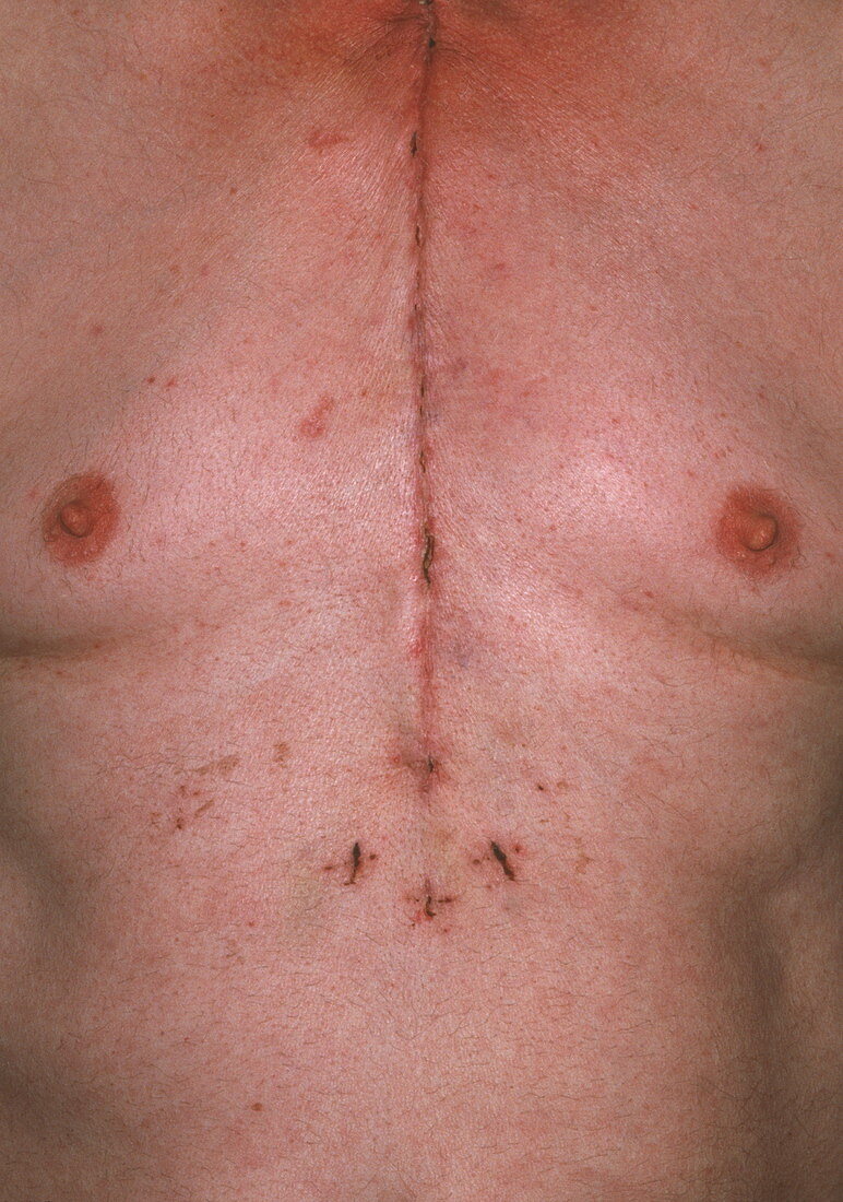 Heart surgery chest scar