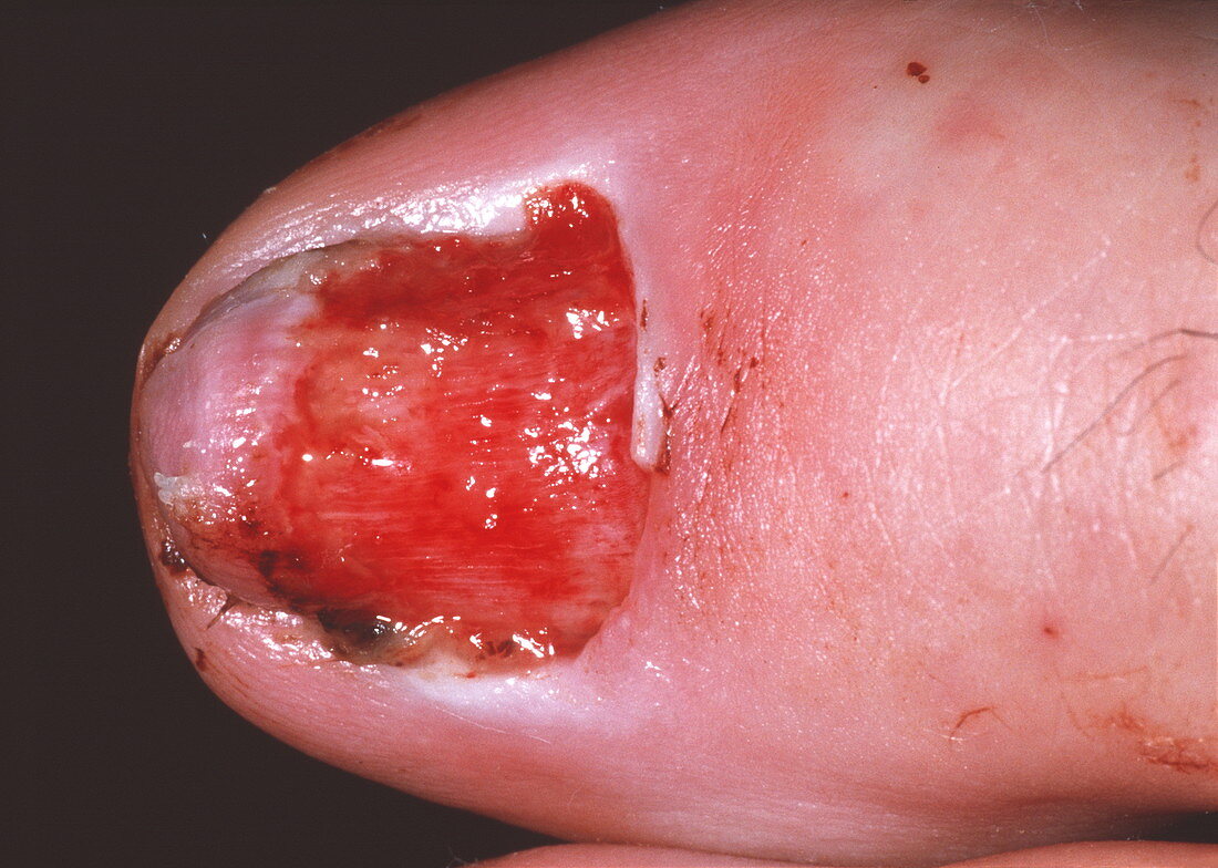 Wound after toenail removal