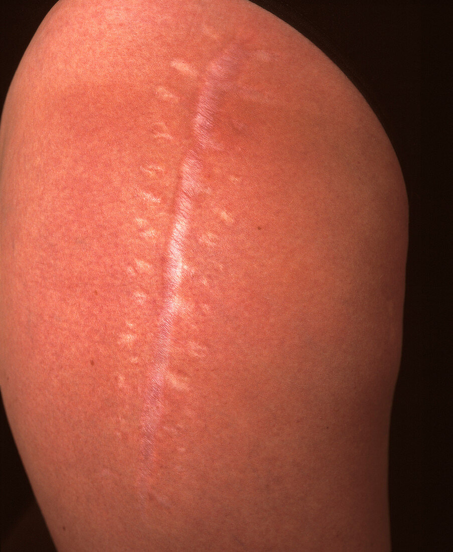 Post-operative leg scar