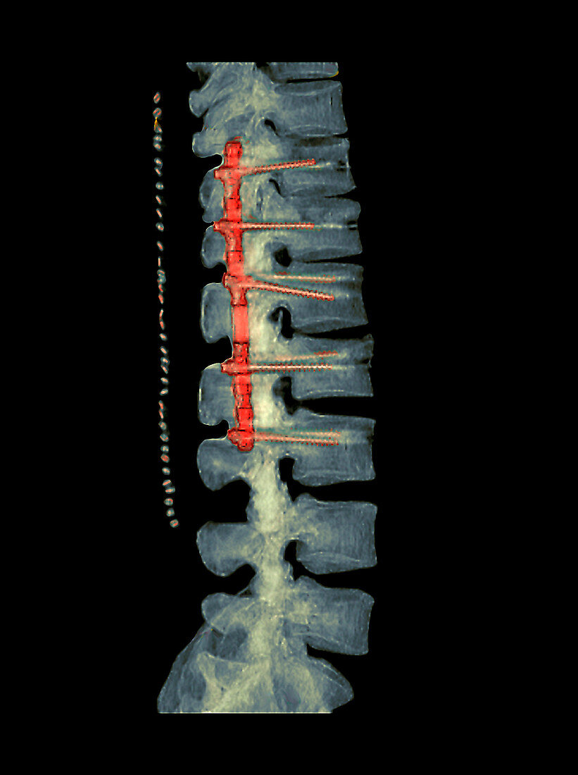 Pinned broken spine,3D CT scan