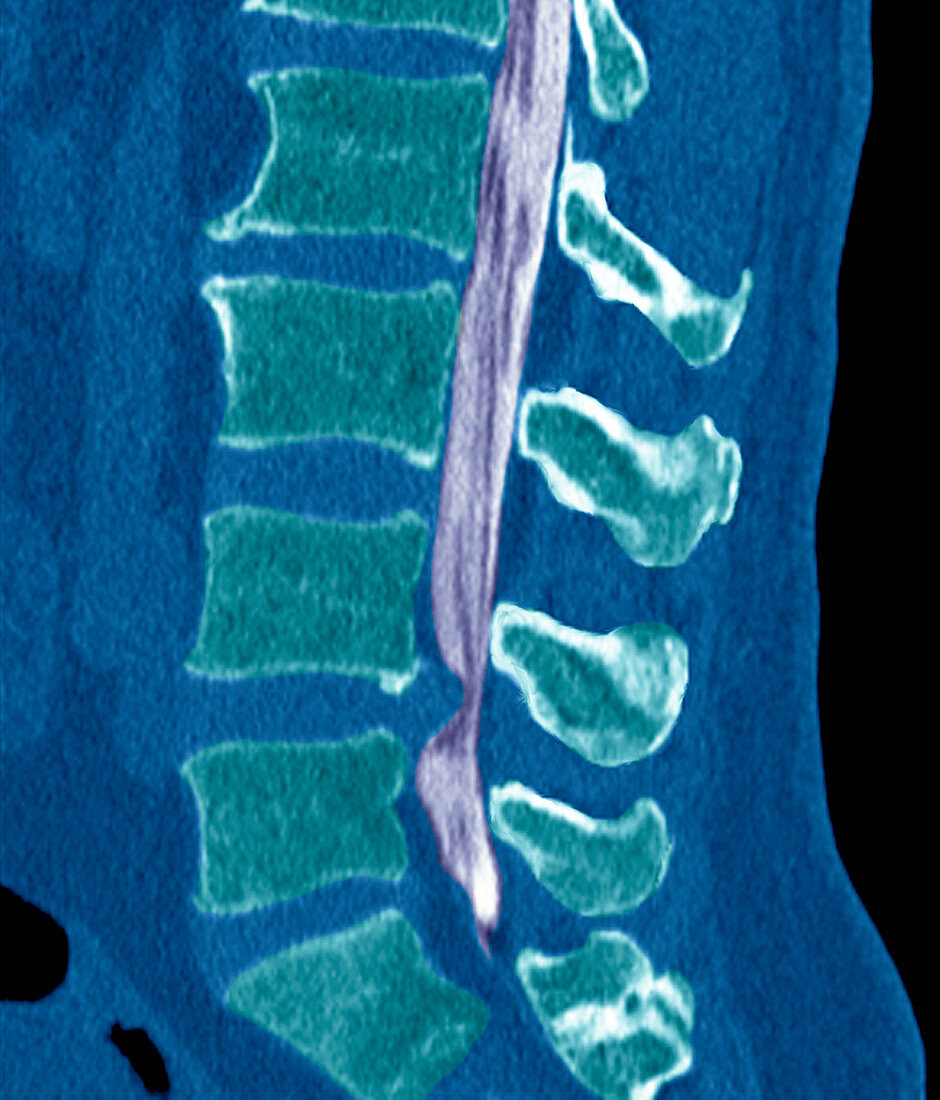 Slipped disc,CT scan