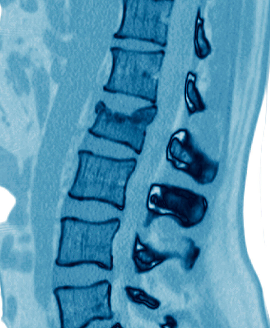 Fractured spine,CT scan