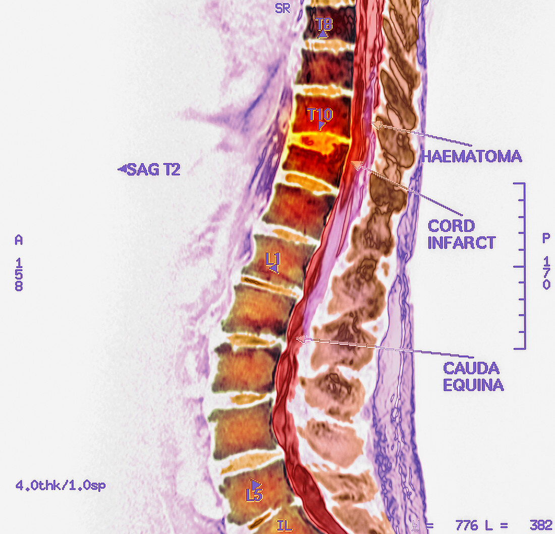 Spinal cord stroke,MRI scan