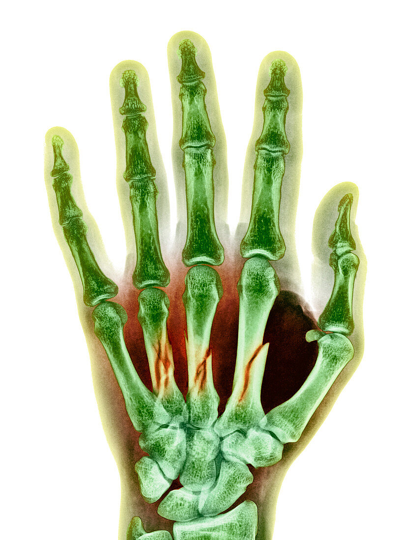 Fractured palm bones of hand,X-ray
