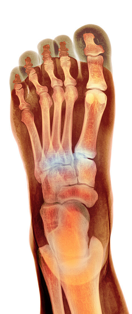 Crushed broken foot,X-ray
