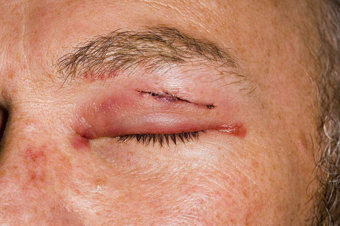 Swollen and bruised eyelid