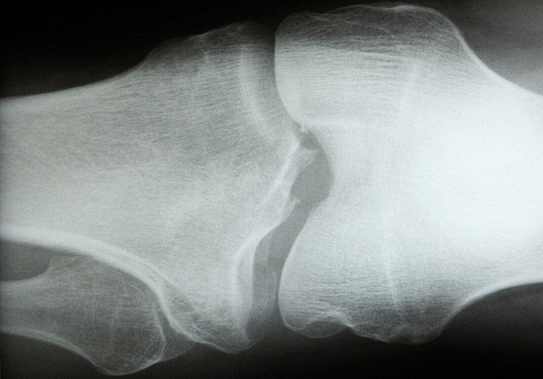 Broken leg,X-ray