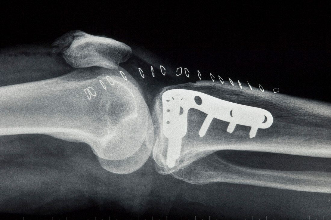 Pinned broken leg,X-ray