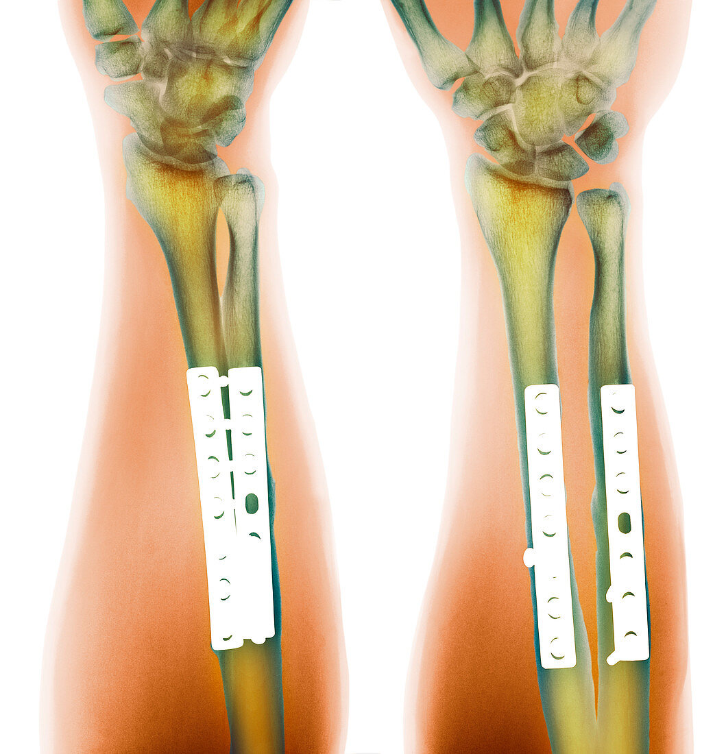 Pinned broken arm,X-ray (2 views)