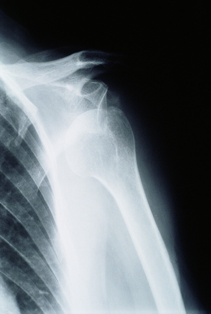 Dislocated shoulder,X-ray