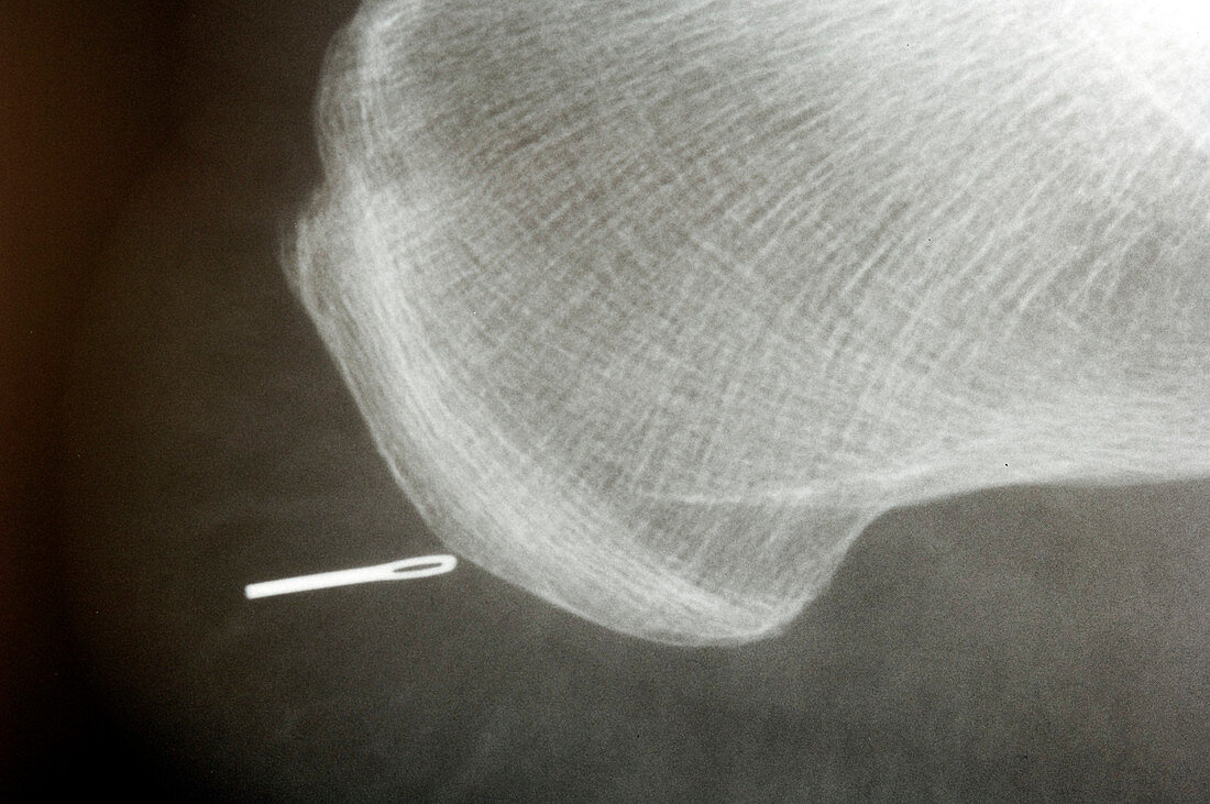 Sewing needle stuck in foot,X-ray