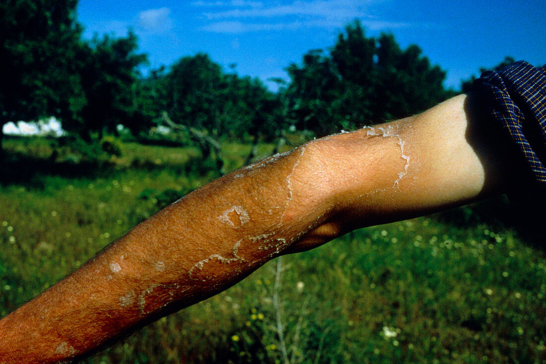 Effects of sunburn on a man's arm