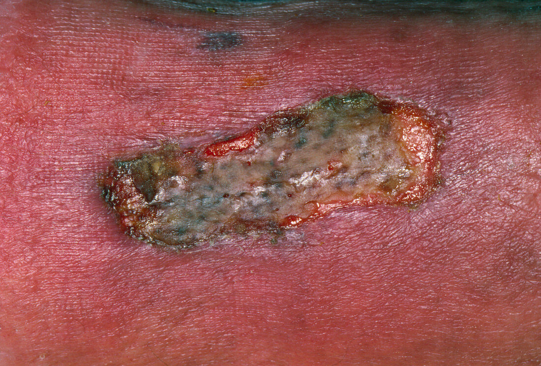 Infected burn on skin on diabetic