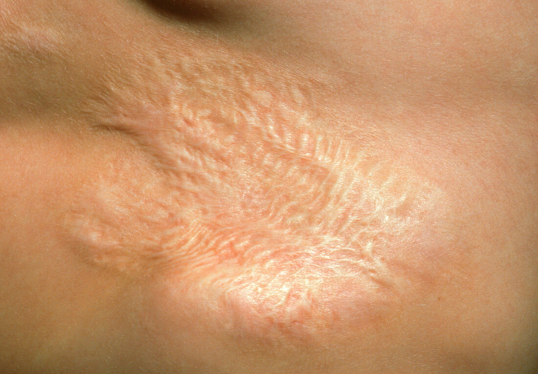 Scar on child's skin due to scalding