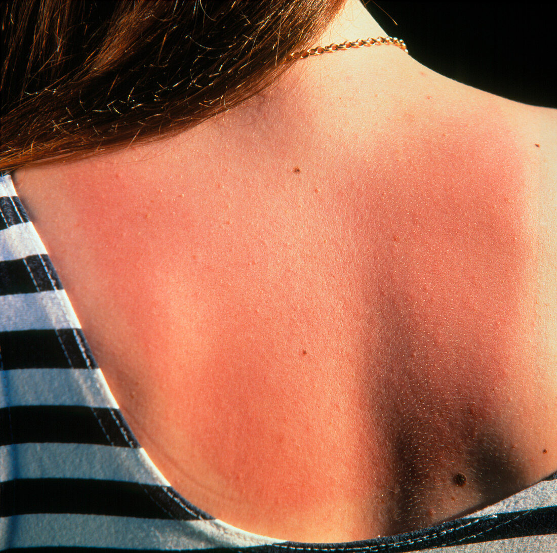 Red skin on the back of a sunburnt woman