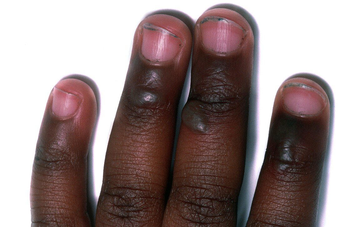 Fingers showing non-accidental second degree burns