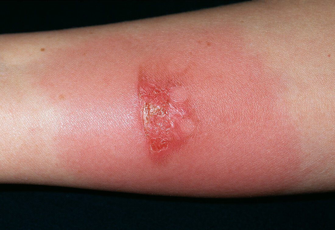 Infected burn