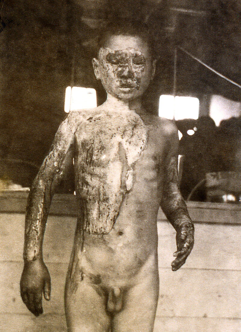 Radiation burns,Nagasaki