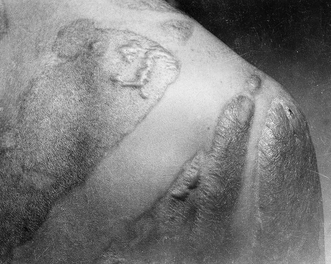Radiation burn scars,Hiroshima,1945