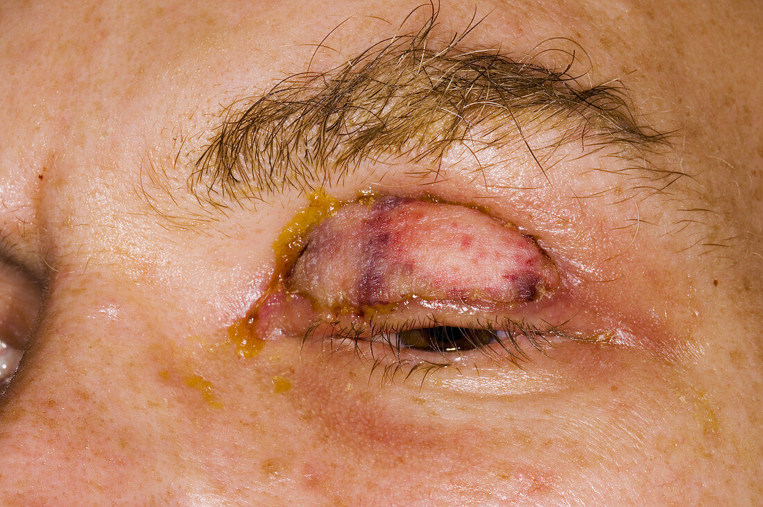 Eyelid skin graft