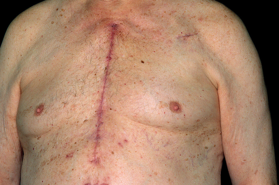 Heart surgery scar