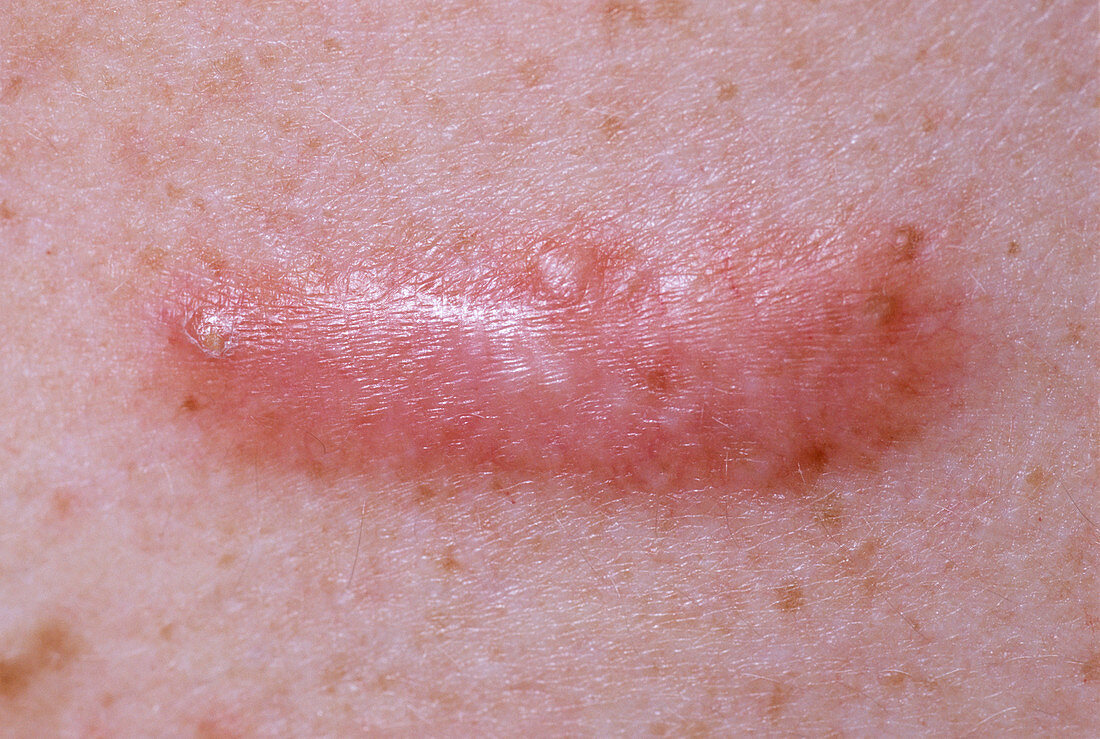 Keloid scar