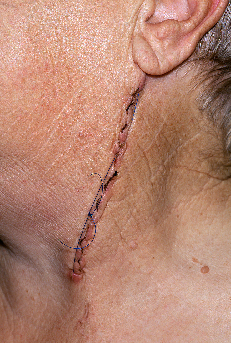 Surgical scar