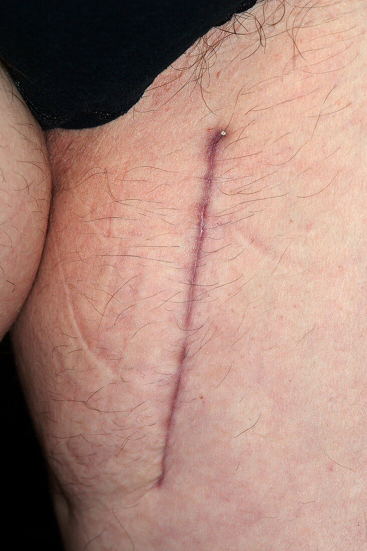 Tumour excision scar