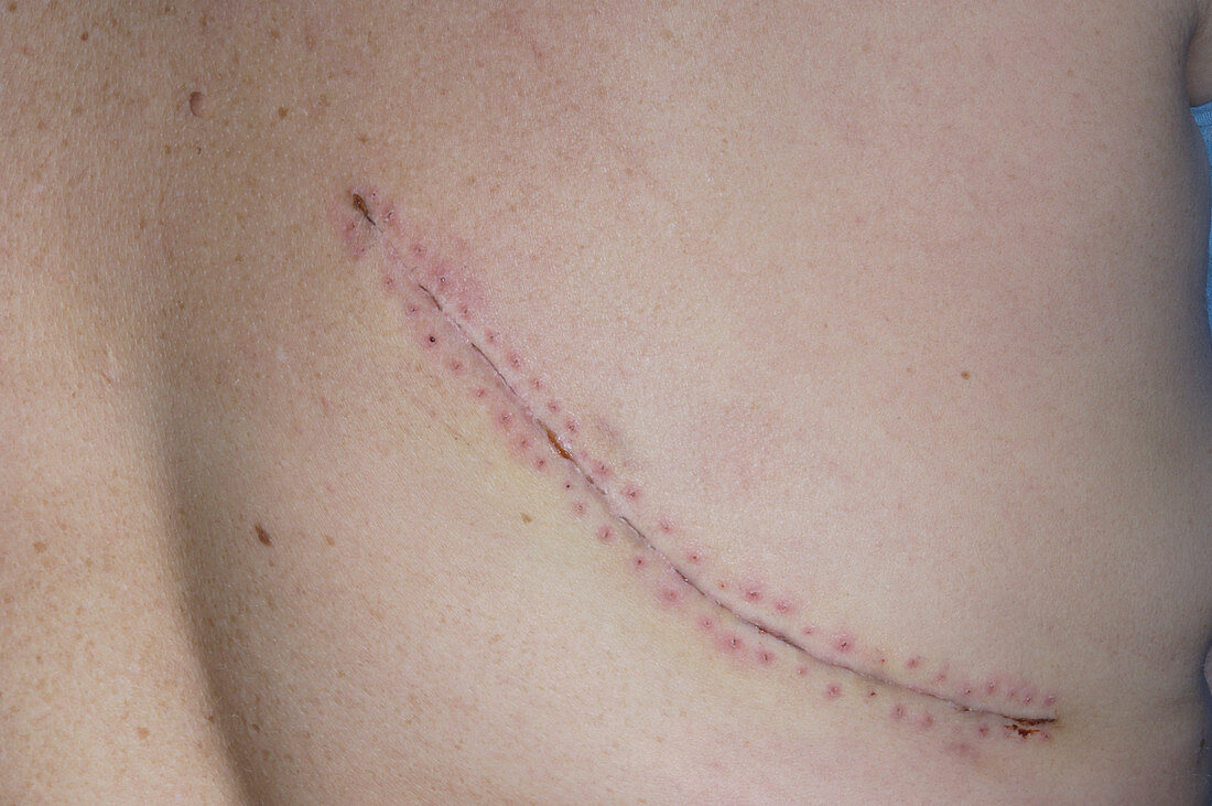 Scar after hernia repair