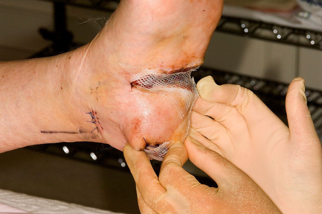 Dressing melanoma excision wound