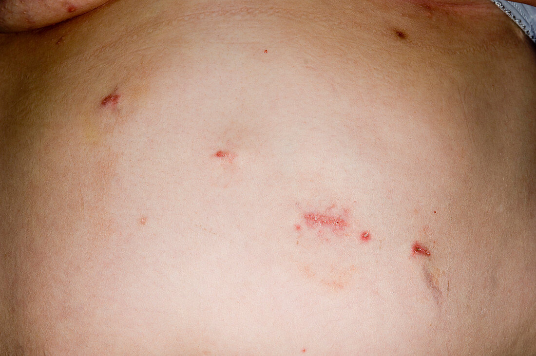 Gastric band surgery wounds