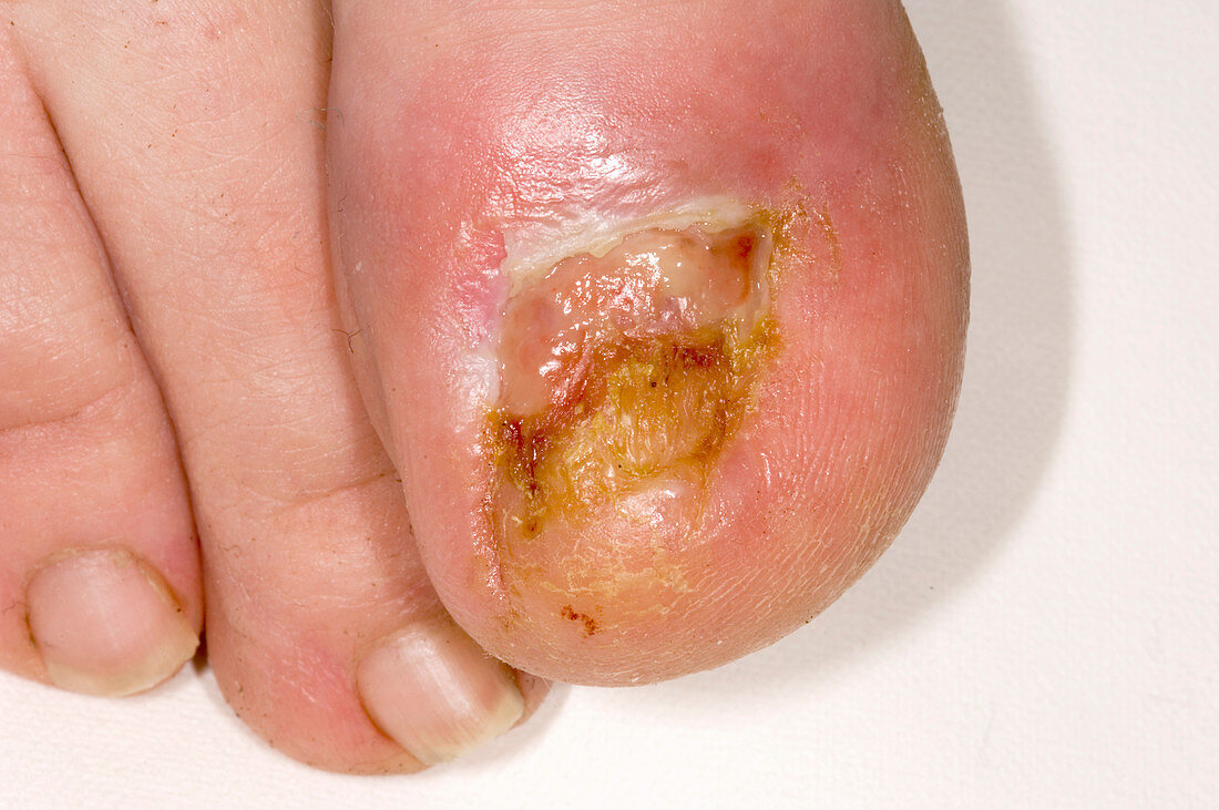 Infected toenail bed after nail removal