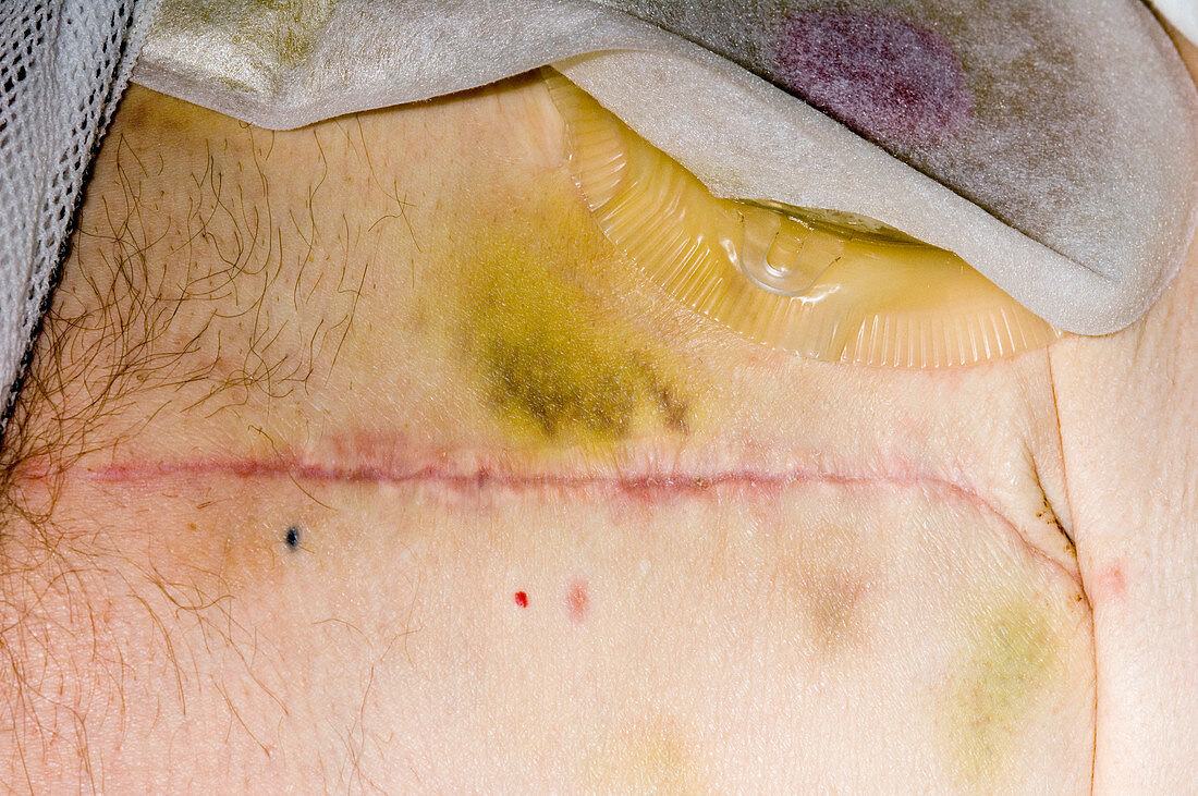 Bladder removal scar