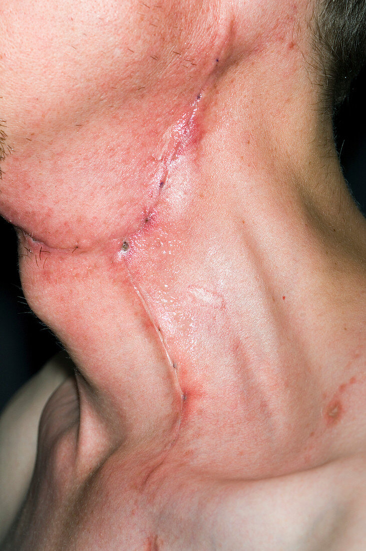 Carcinoma excision scar