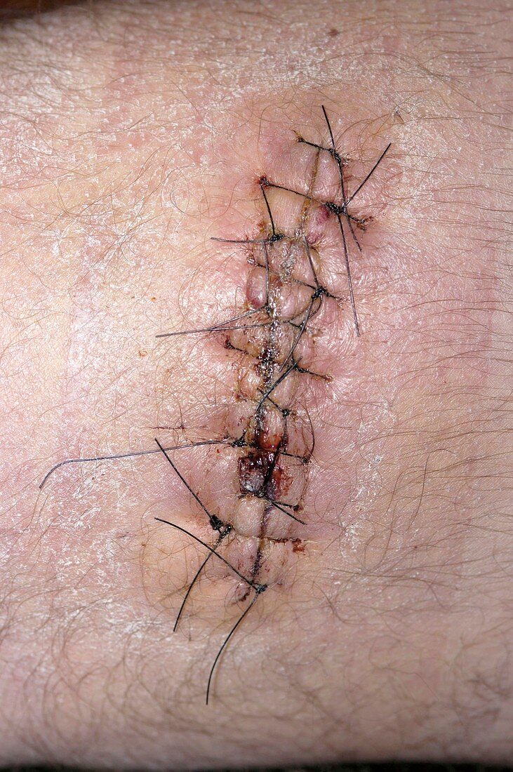 Stitched scar following surgery