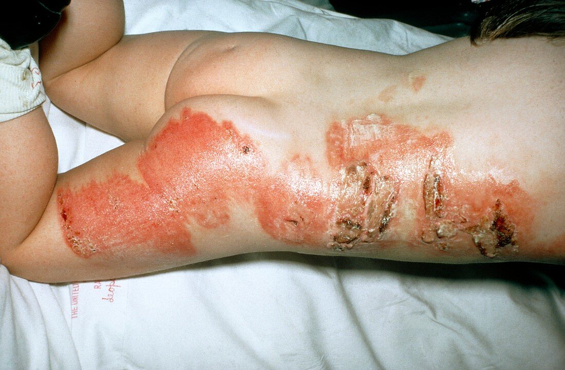 1st and 2nd degree burns on young child's body