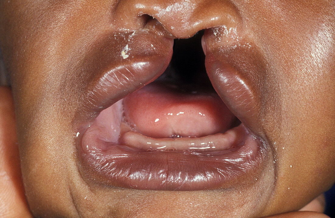 Cleft palate